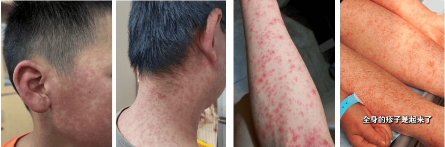 超6000例！仍在新增！或发展成慢性病及有后遗症！上海华山医院：这些驱蚊产品没用！